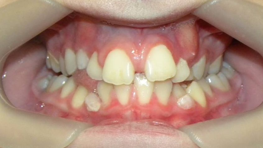 Frontal (Oclusión)
