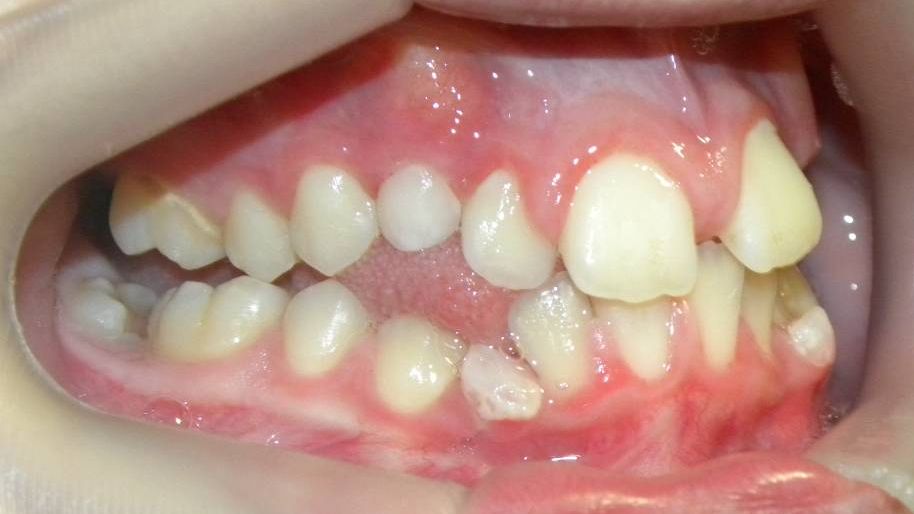 Lateral Derecha
