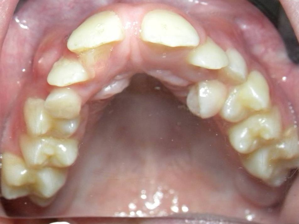 Oclusal Superior
