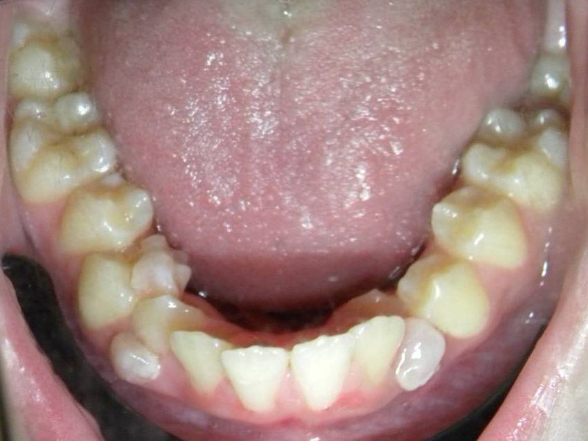 Oclusal Inferior
