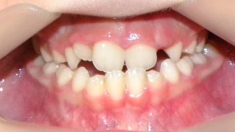 Frontal (Oclusión)