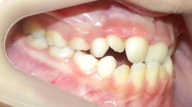 Lateral Derecha