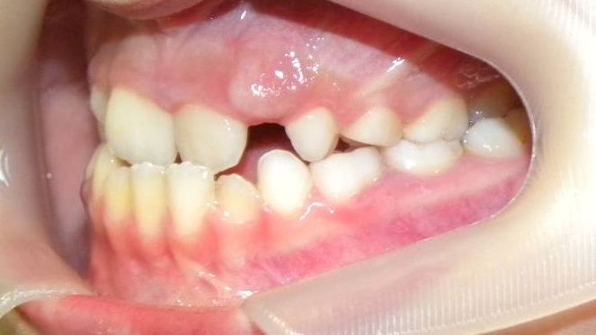 Lateral Izquierda
