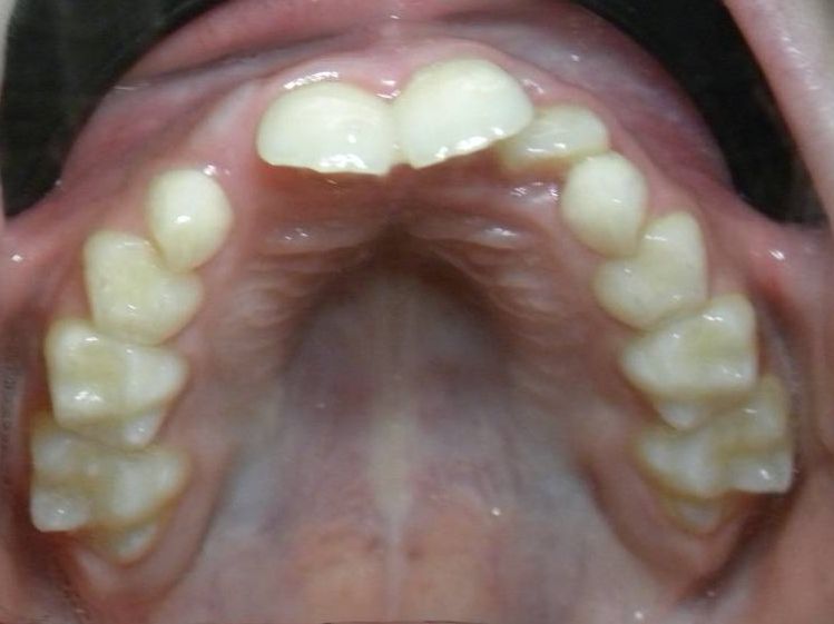 Oclusal Superior
