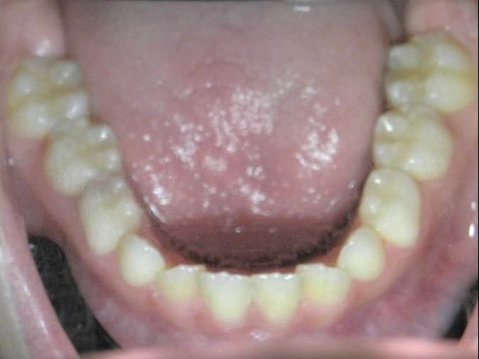 Oclusal Inferior