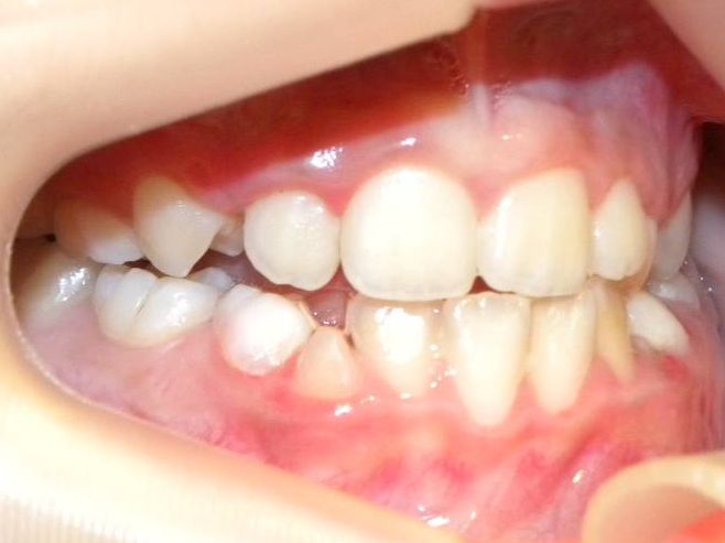 Lateral Derecha