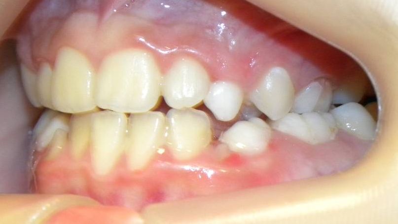 Lateral Izquierda