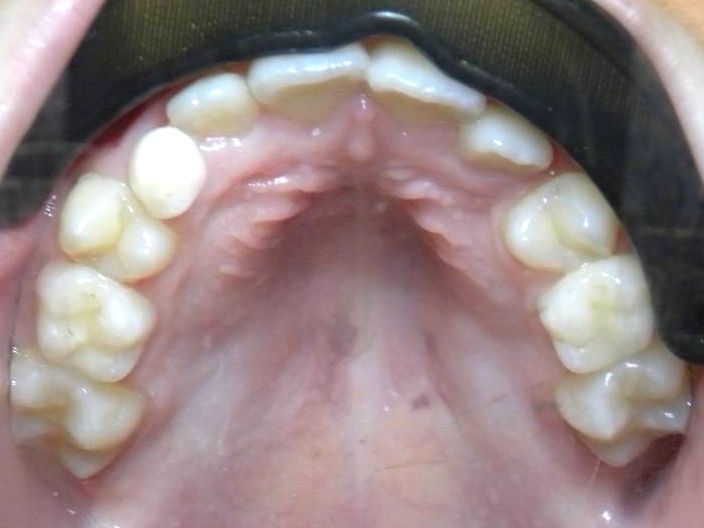 Oclusal Superior