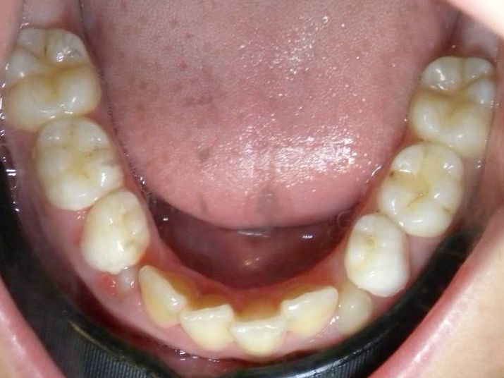 Oclusal Inferior
