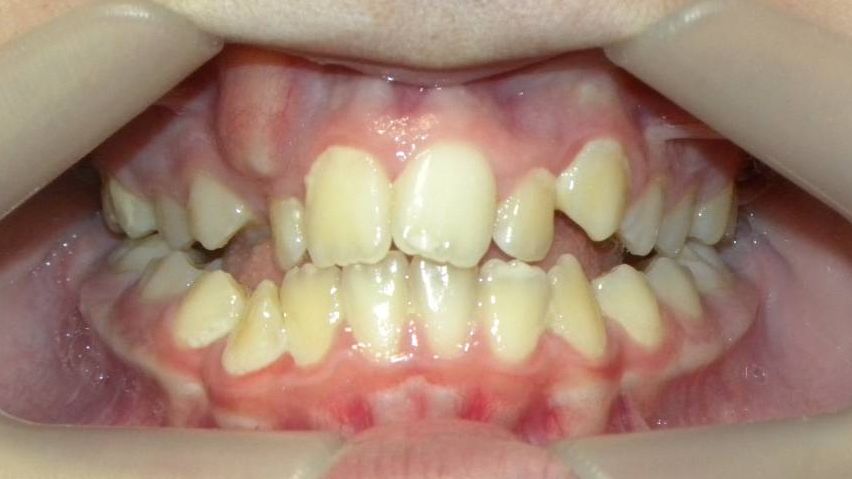 Frontal (Oclusión)