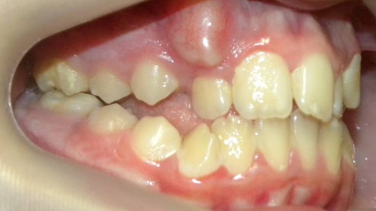 Lateral Derecha