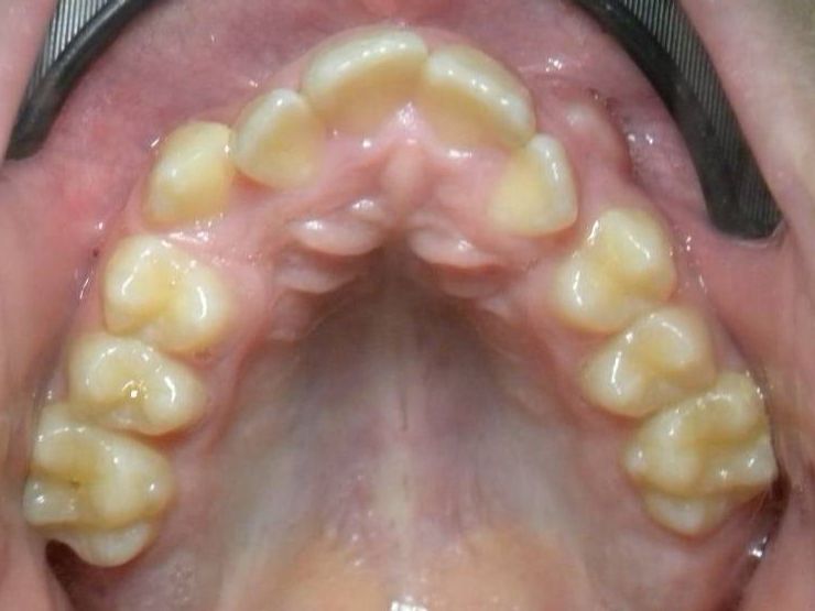 Oclusal Superior