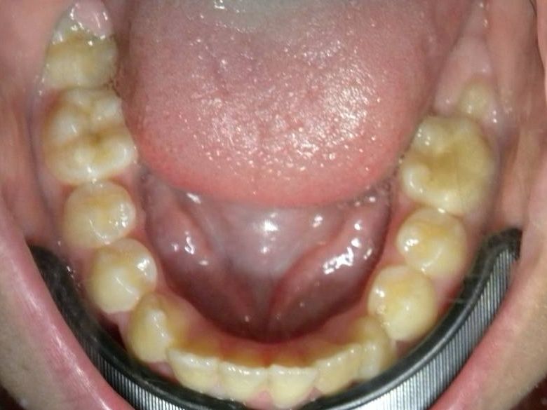 Oclusal Inferior