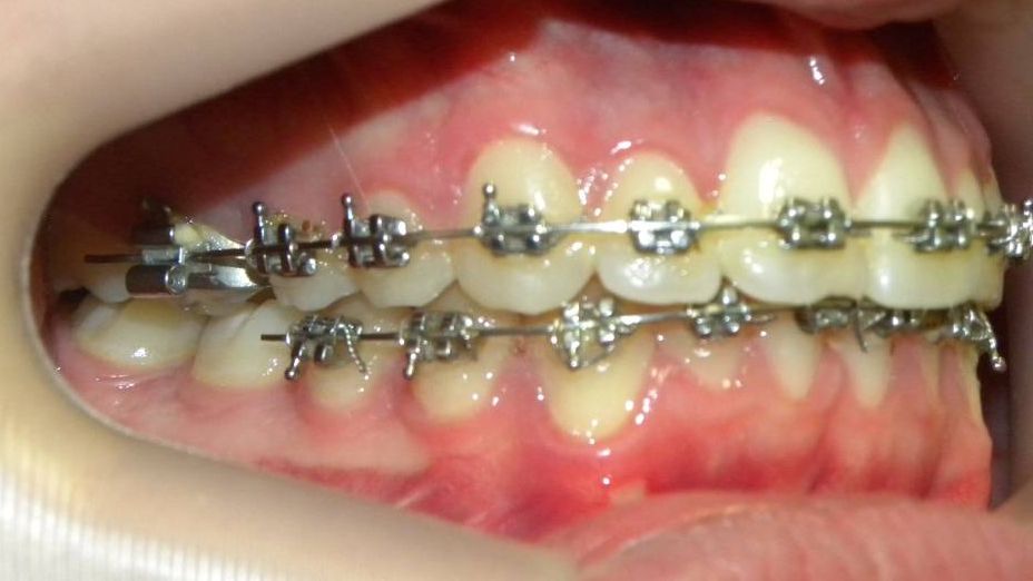 Lateral Derecha