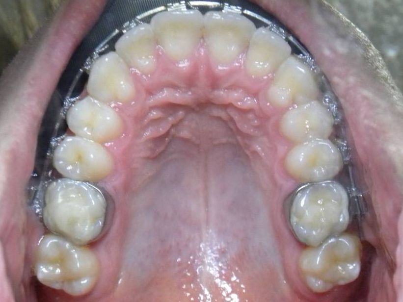 Oclusal Superior