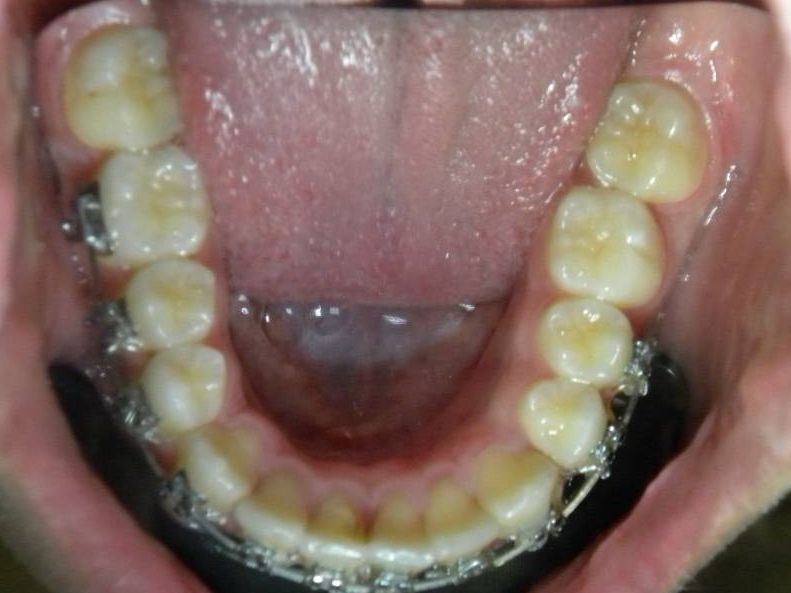 Oclusal Inferior