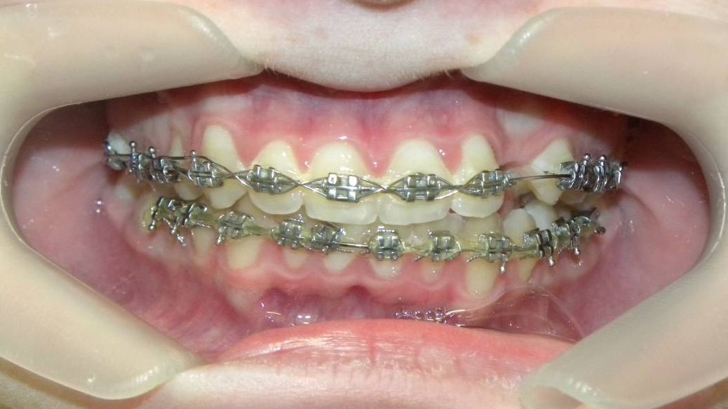 Frontal (Oclusión)