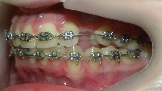 Lateral Izquierda