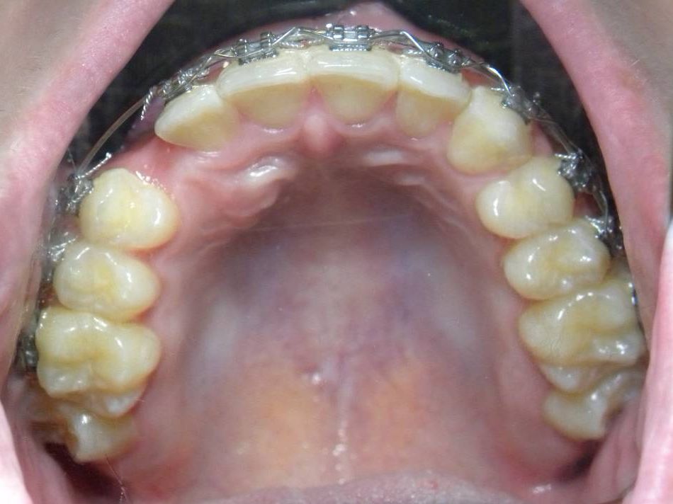 Oclusal Superior