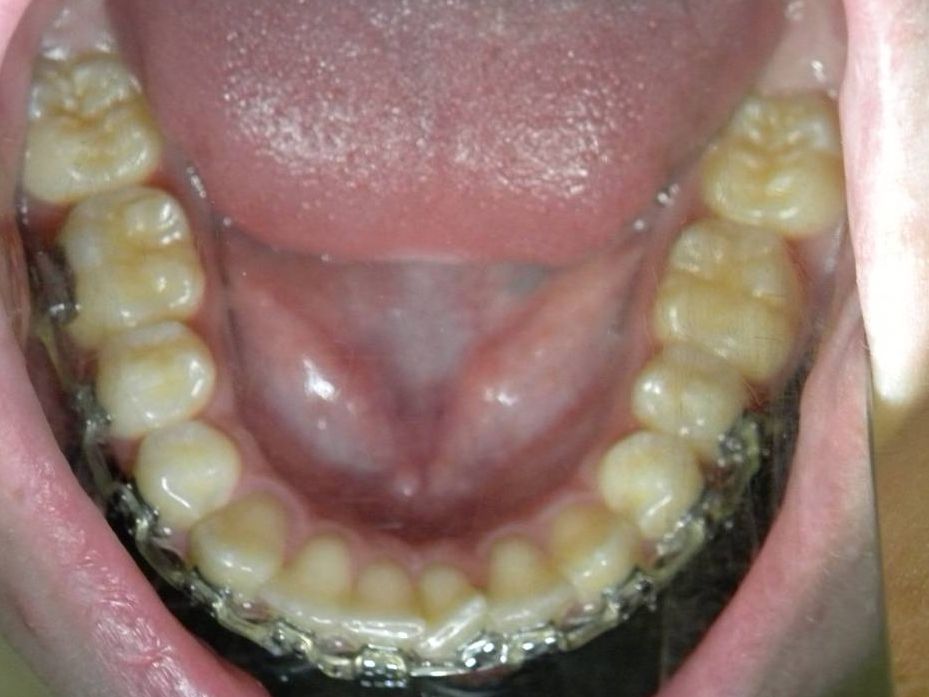Oclusal Inferior