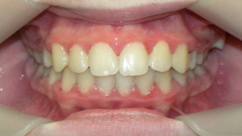 Frontal (Oclusión)