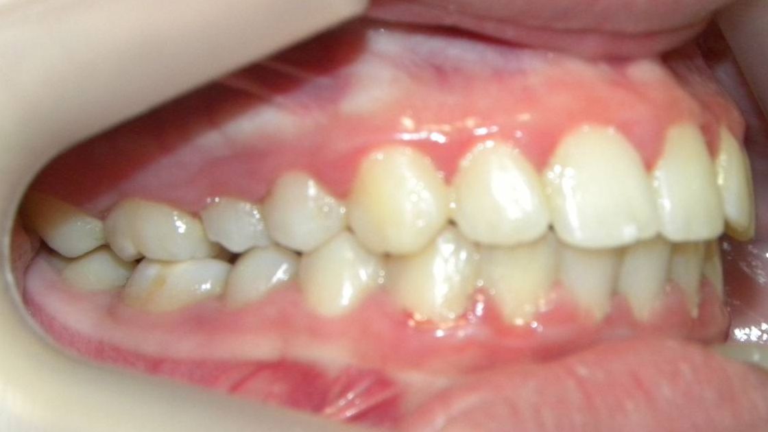 Lateral Derecha
