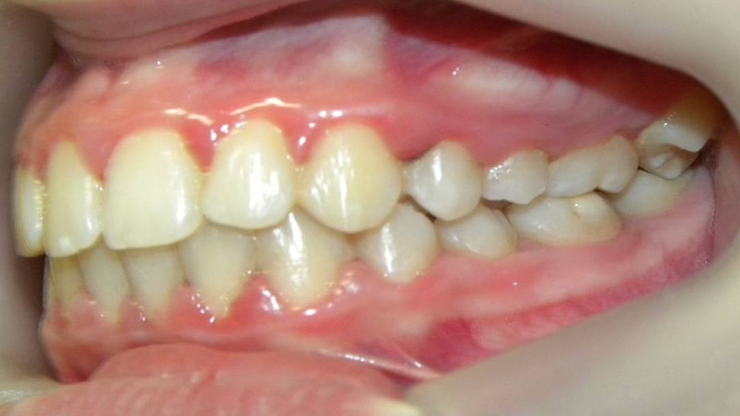 Lateral Izquierda
