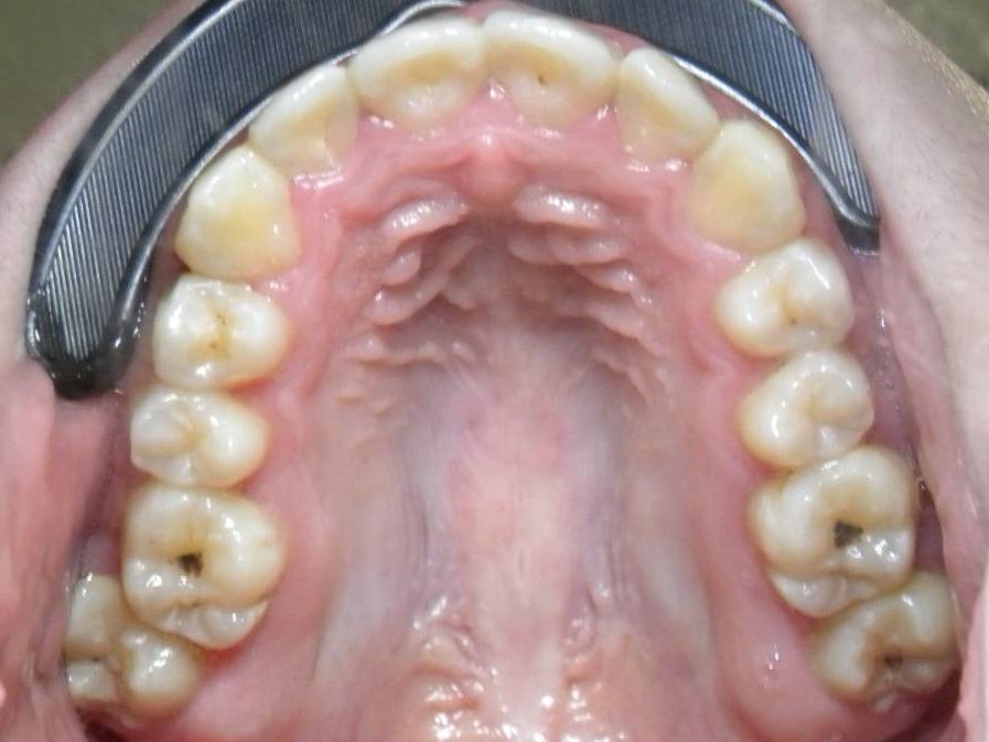 Oclusal Superior