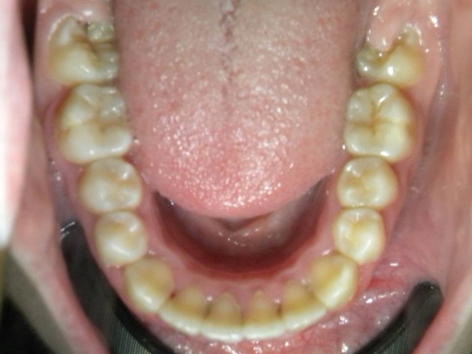 Oclusal Inferior