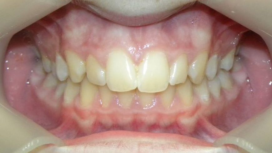 Frontal (Oclusión)