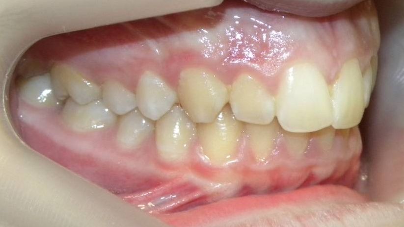 Lateral Derecha