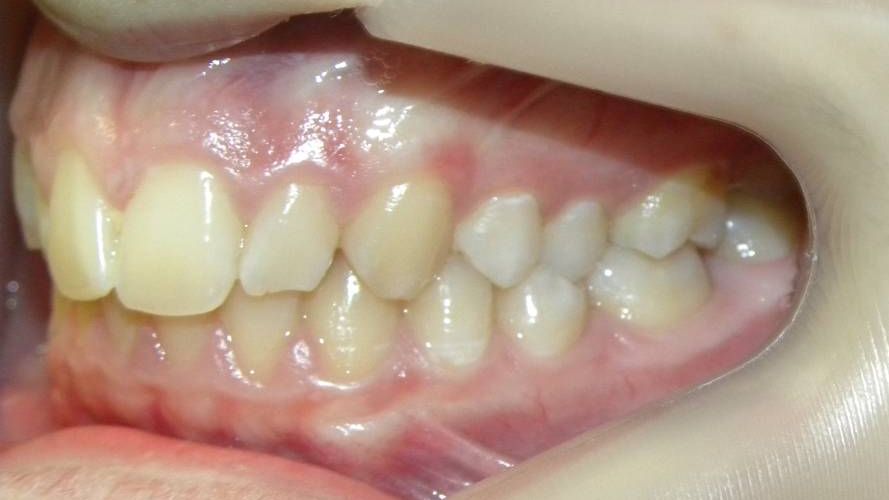 Lateral Izquierda