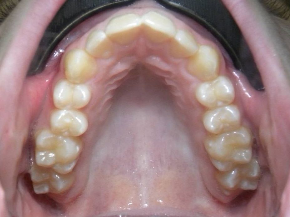 Oclusal Superior