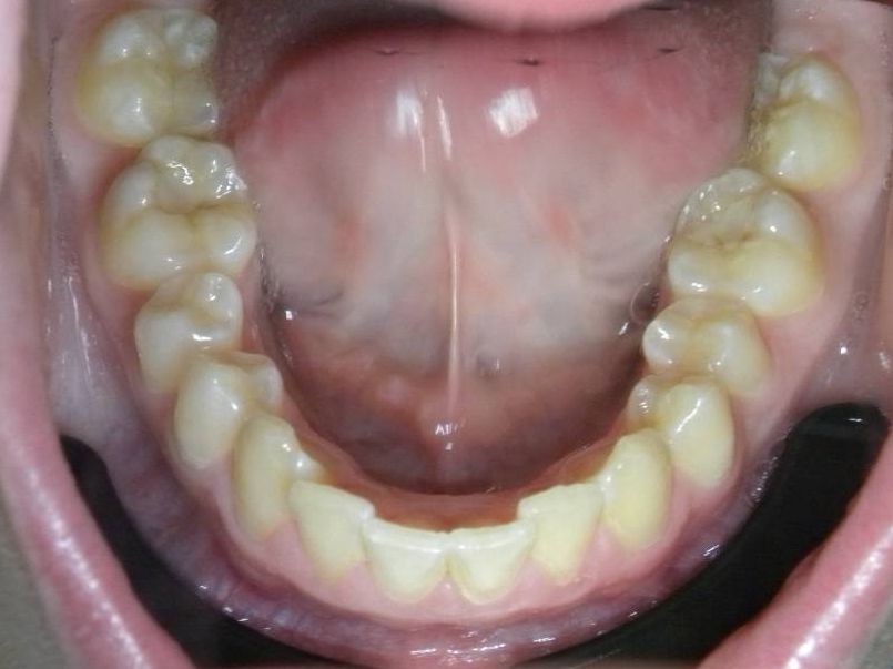 Oclusal Inferior