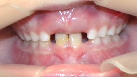 Frontal (Oclusión)
