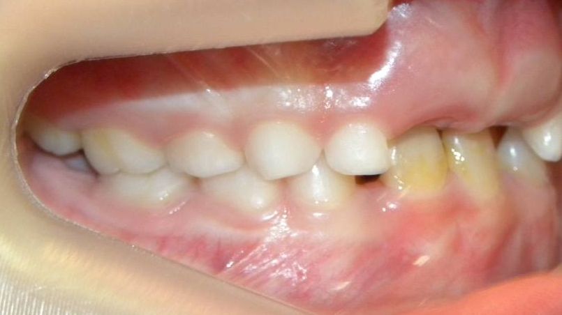 Lateral Derecha