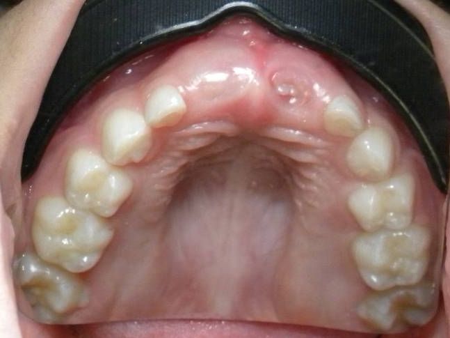Oclusal Superior