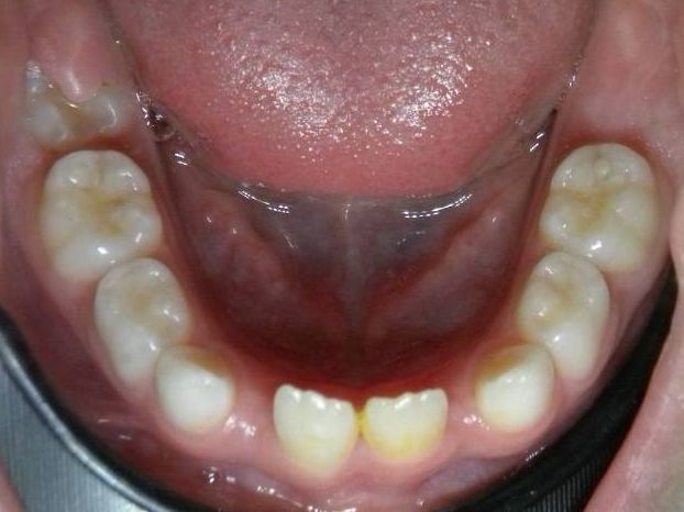 Oclusal Inferior