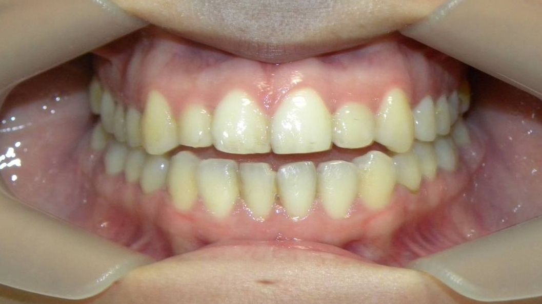 Frontal (Oclusión)