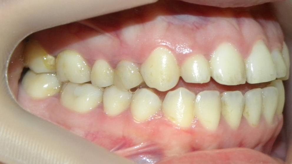 Lateral Derecha