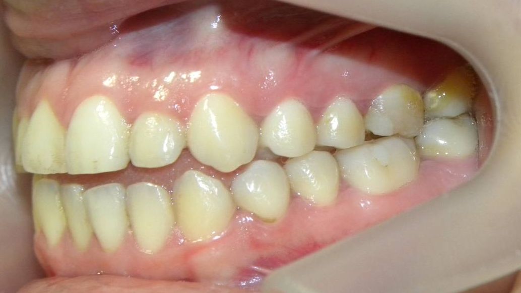 Lateral Izquierda