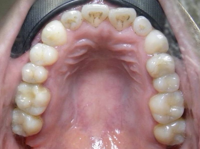 Oclusal Superior