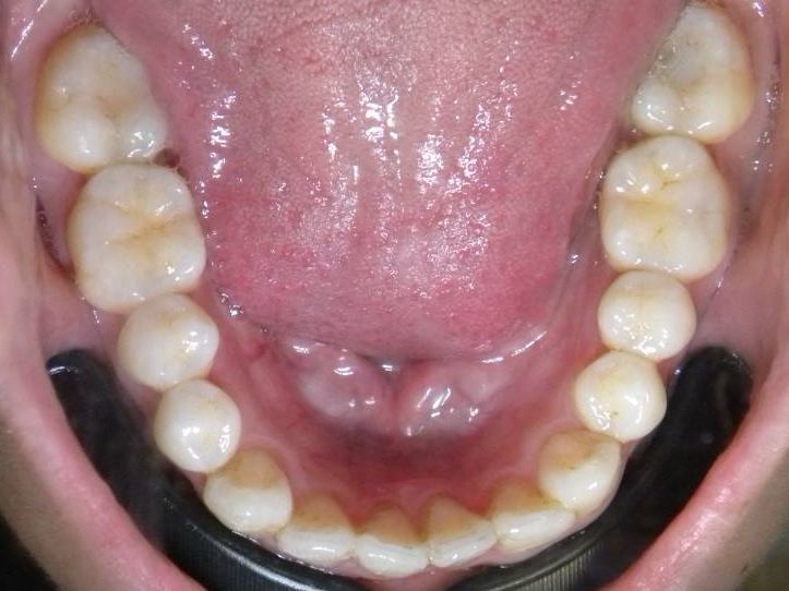 Oclusal Inferior