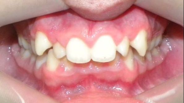 Frontal (Oclusión)