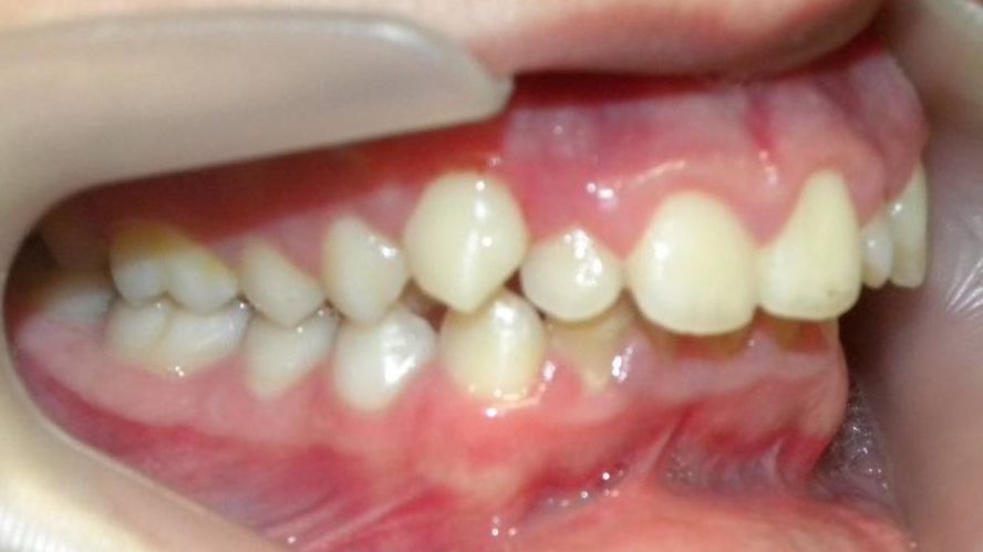Lateral Derecha