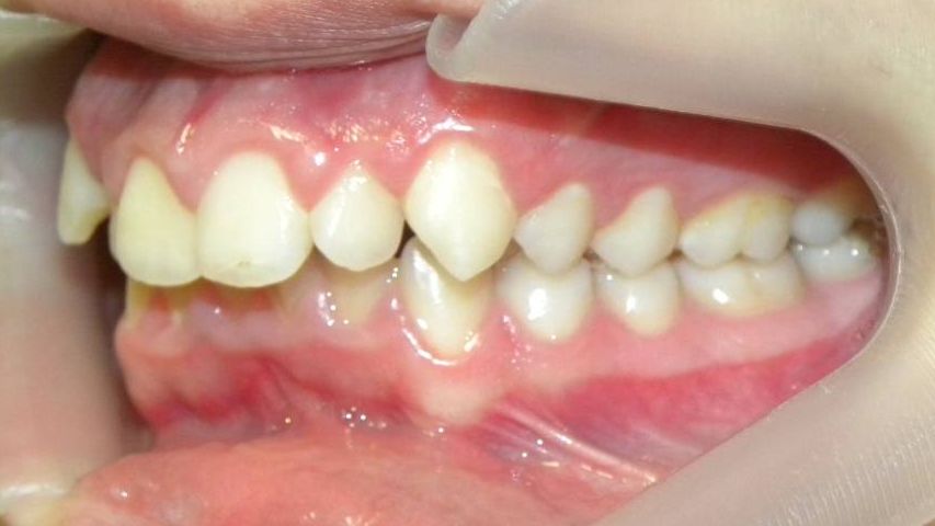 Lateral Izquierda