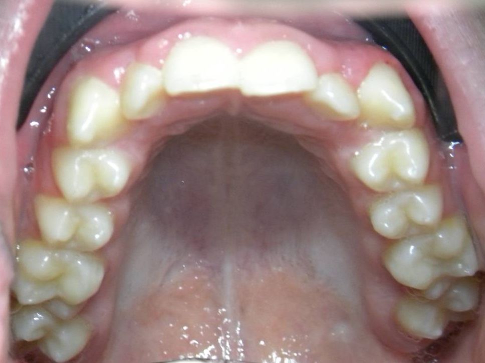 Oclusal Superior