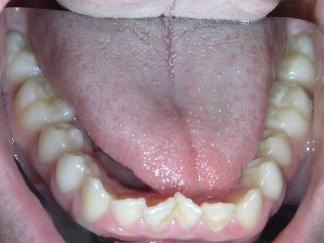 Oclusal Inferior
