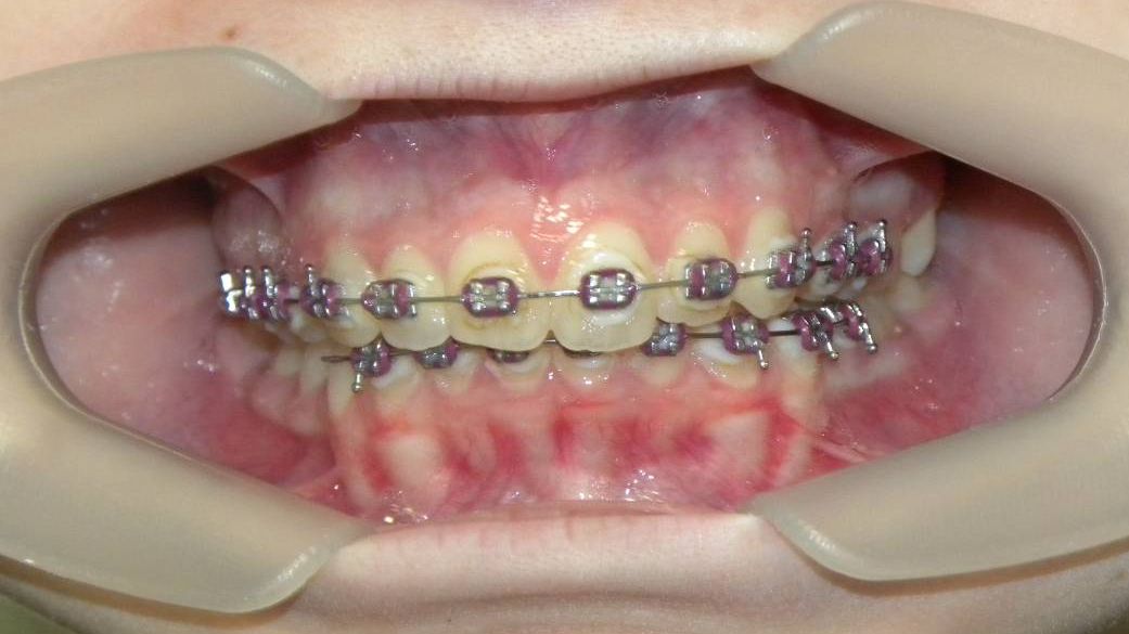 Frontal (Oclusión)