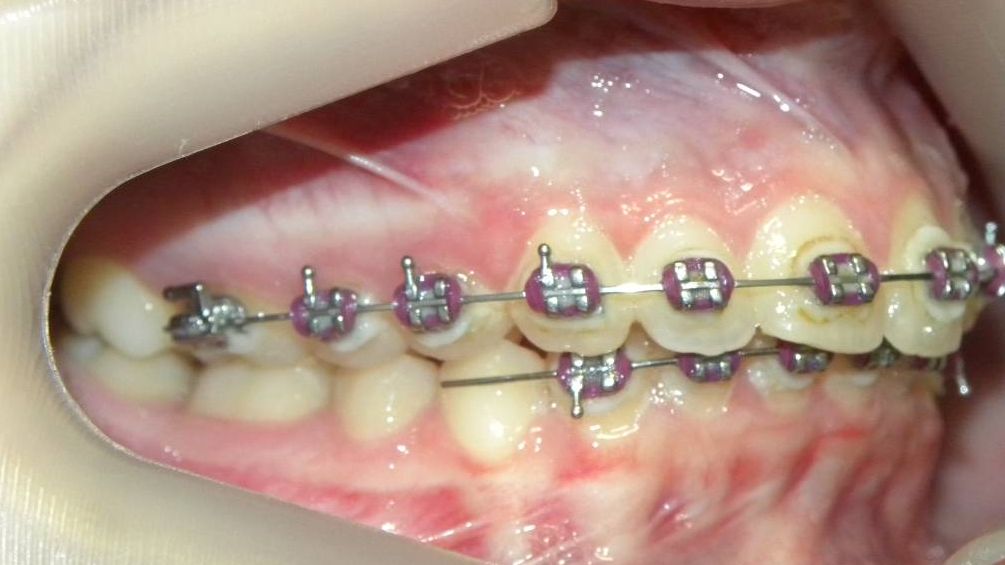 Lateral Derecha